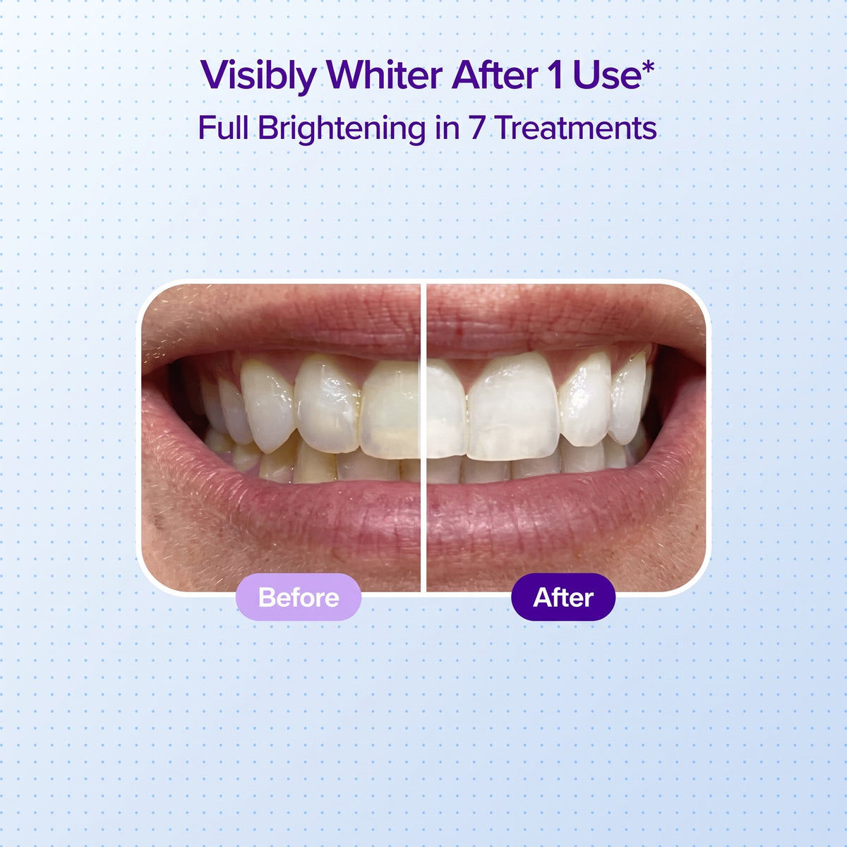 Vitadose Teeth Whitening Strips-5 Strips